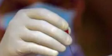 Mucormycosis kills 16 in Aurangabad in second wave