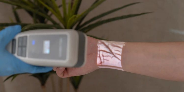 Veins Will No Longer Be Missed, They Will Appear Clearly on the Screen